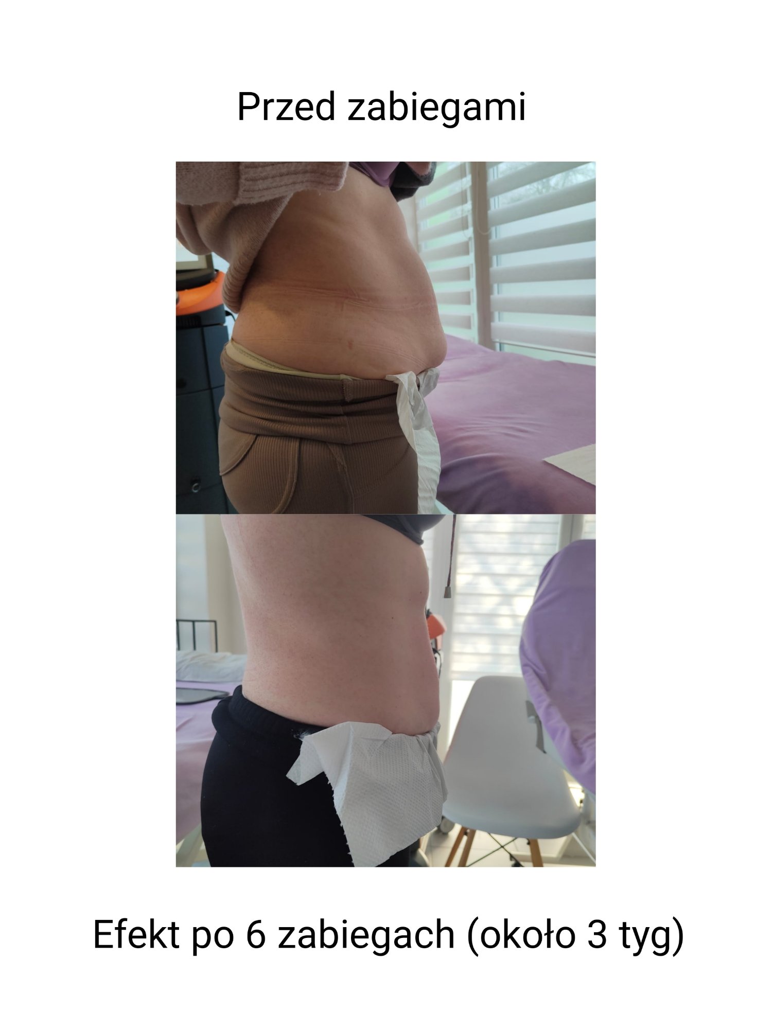 Efekt po 6 zabiegach Indiba na brzuch – widok z boku