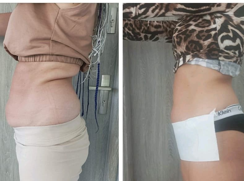 Efekt po zabiegach Indiba na brzuch – przed i po